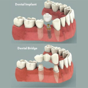 bridge_vs_implant