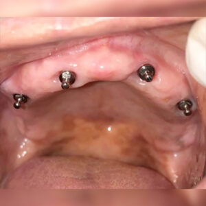 dental implants full mouth