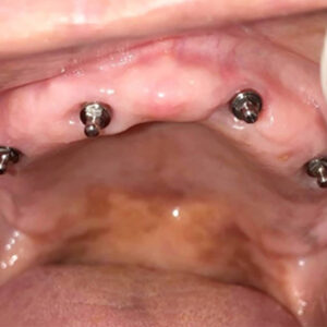 dental implants full mouth