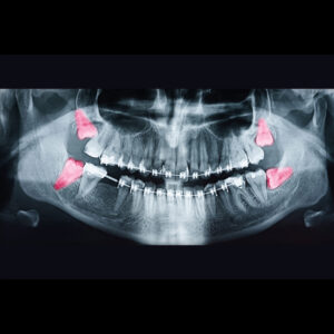 ourservices_wisdomteeth