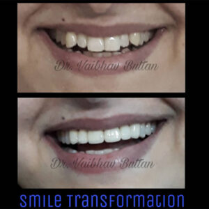 smile trans 19