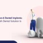 All on 4 vs All on 6 Dental Implants Which Full Mouth Dental Solution Is Right for You 85x85